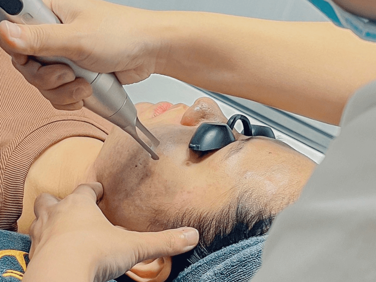 Dịch vụ Laser CO2 Fractional