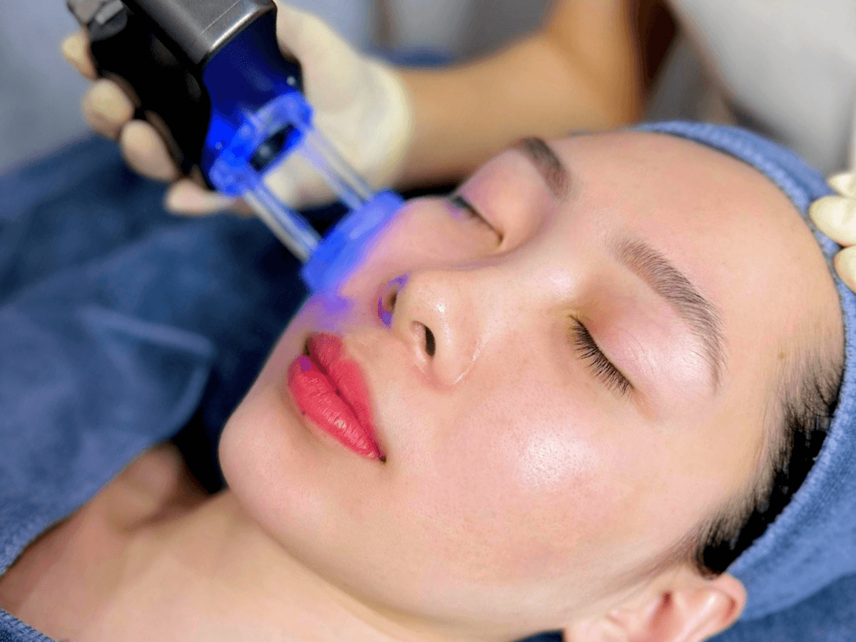 Dịch vụ Laser Tàn Nhang - Nám