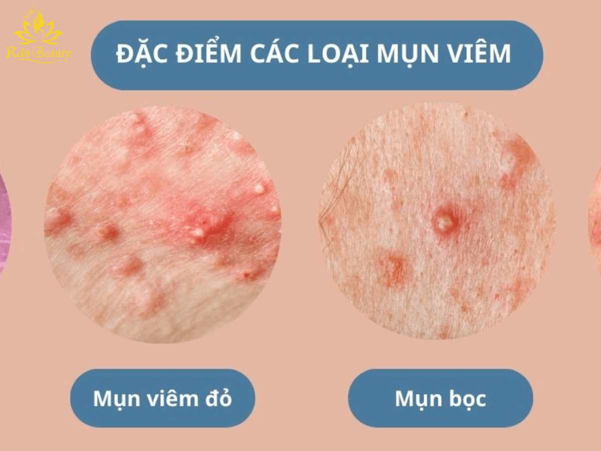 Các loại mụn phổ biến bạn nên biết