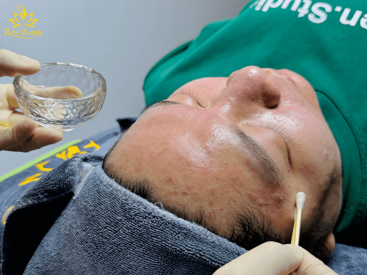 Chemical Peel một phương pháp để điều trị mụn bọc