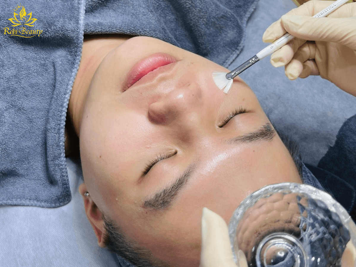 Chemical Peel một phương pháp điều trị mụn đầu đen phổ biến hiện nay