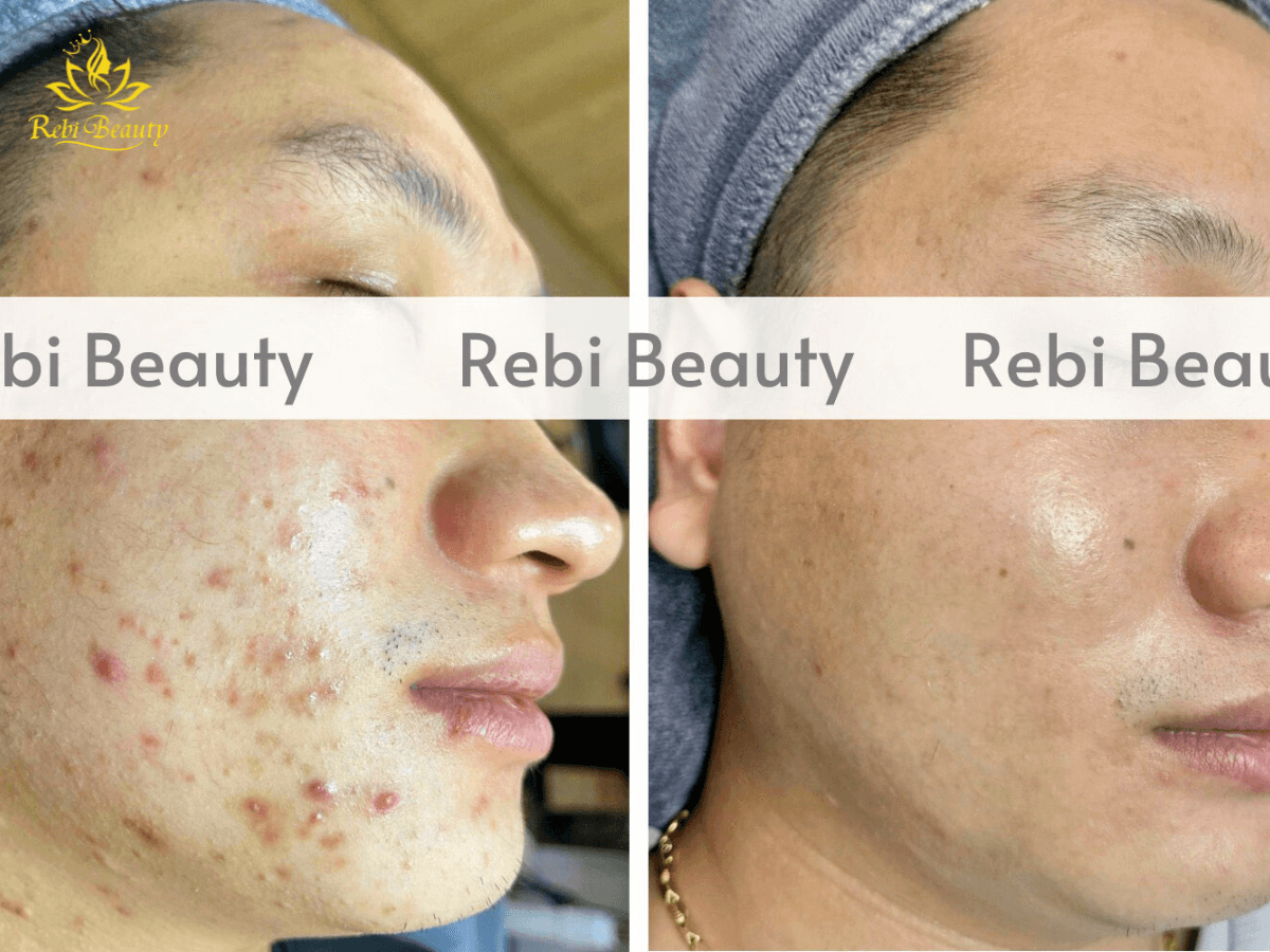 Chemical Peel sẽ giúp loại bỏ mụn, vết thâm & sắc tố không đều màu