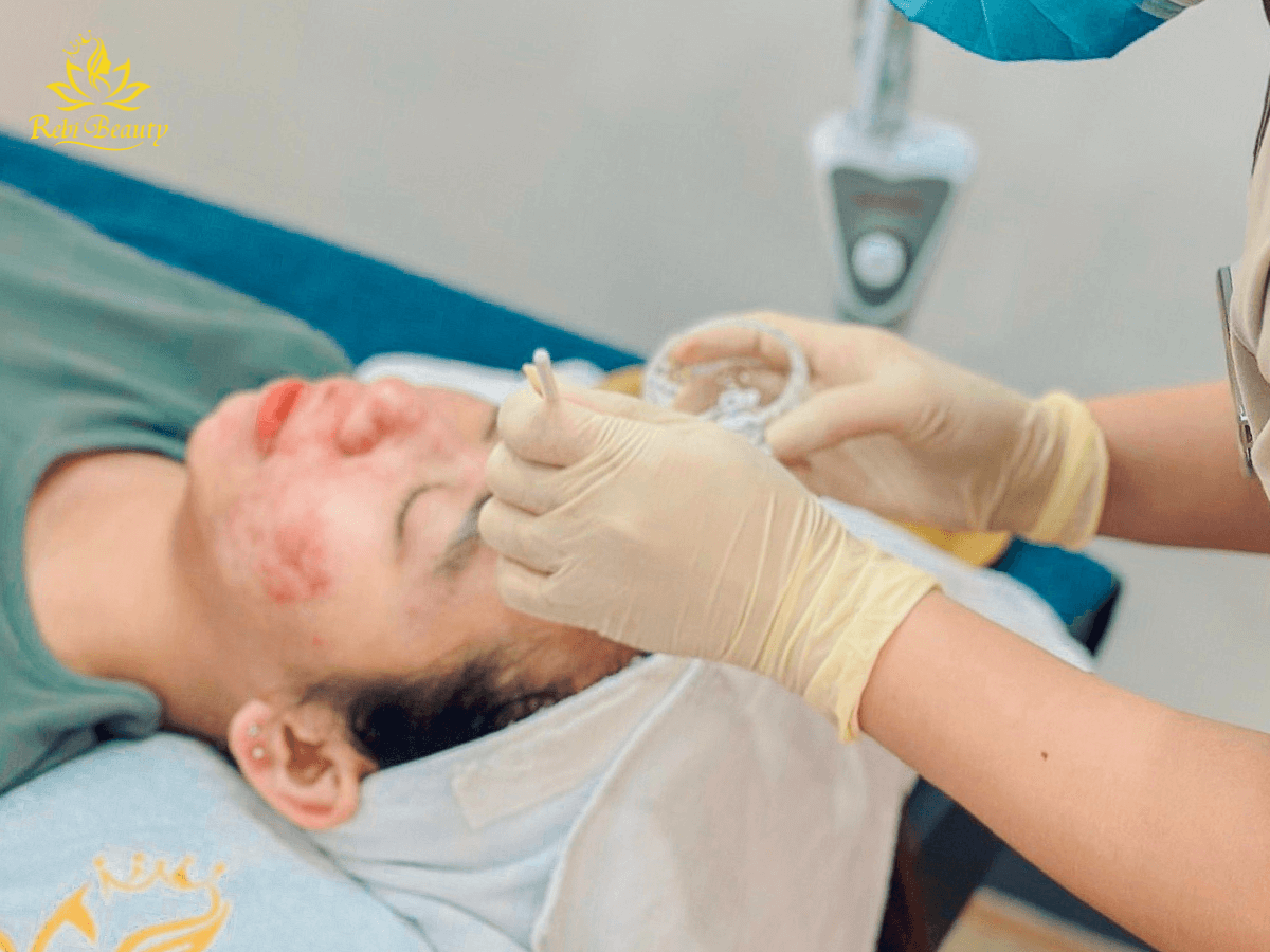 Chemical peel là một phương pháp làm đẹp hiện đại