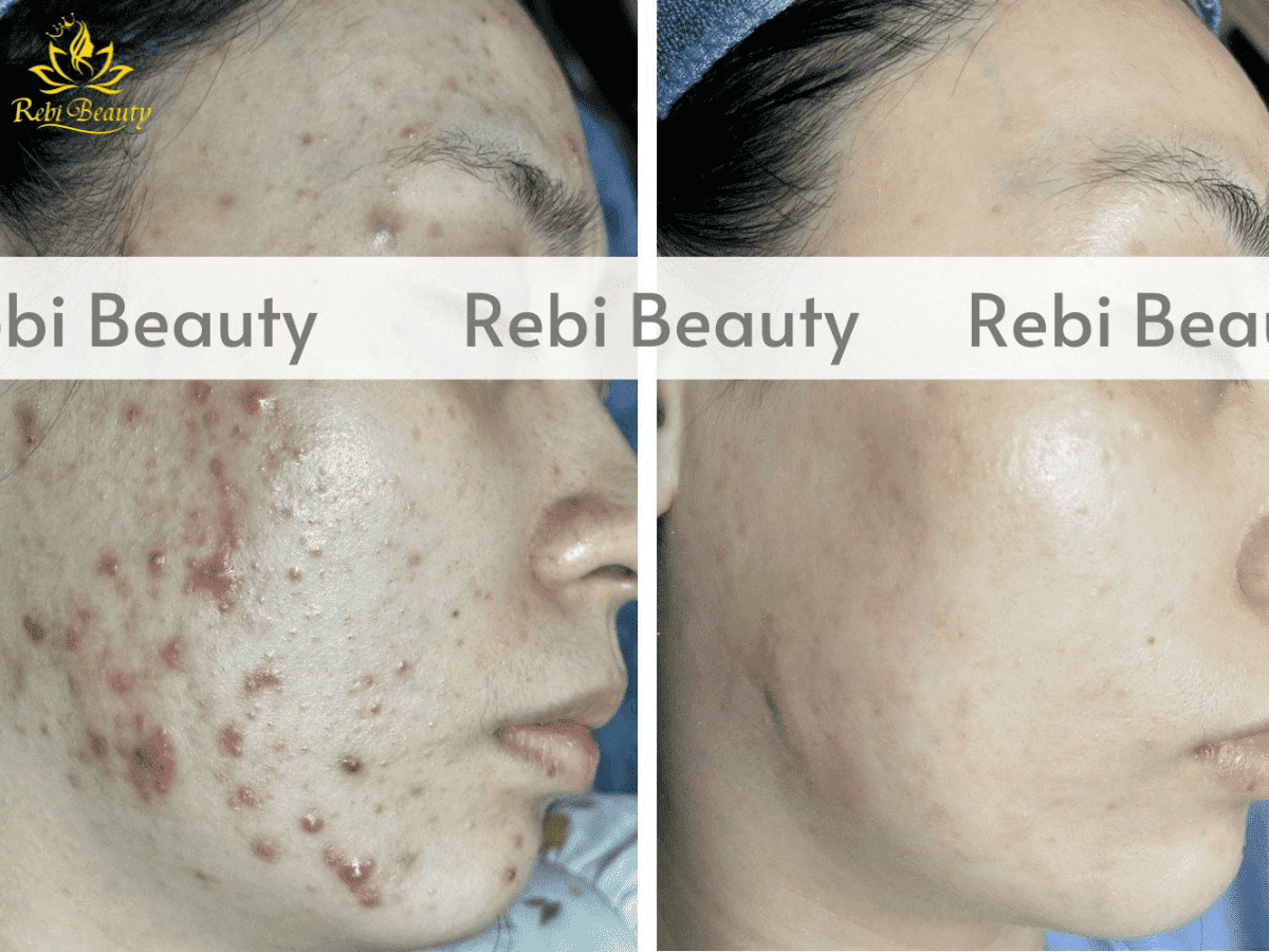 Da cần khoảng 7 – 21 ngày để phục hồi sau khi peel