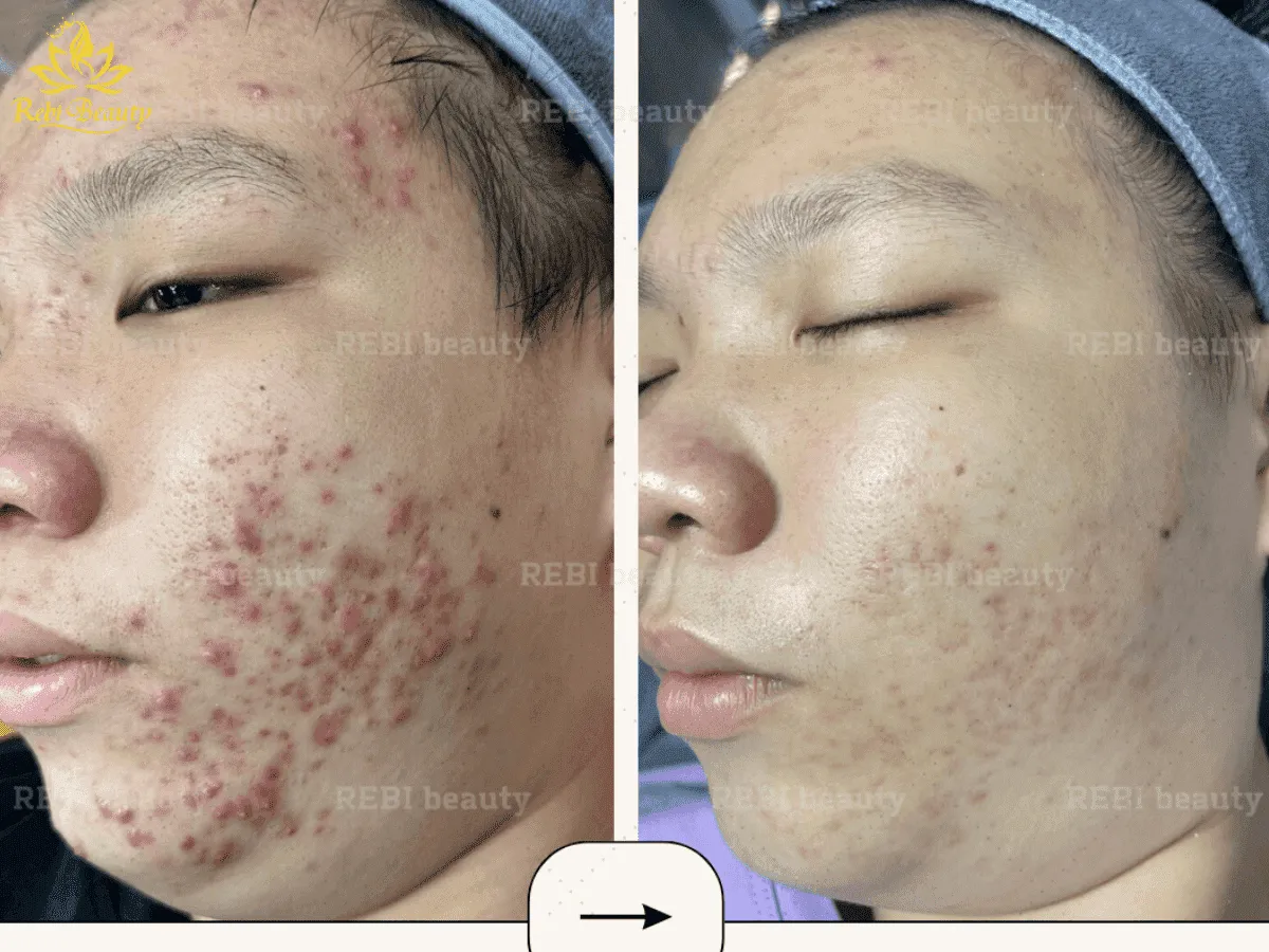 Kết hợp bôi thoa và uống kháng sinh khi mụn bị viêm nhiễm nặng