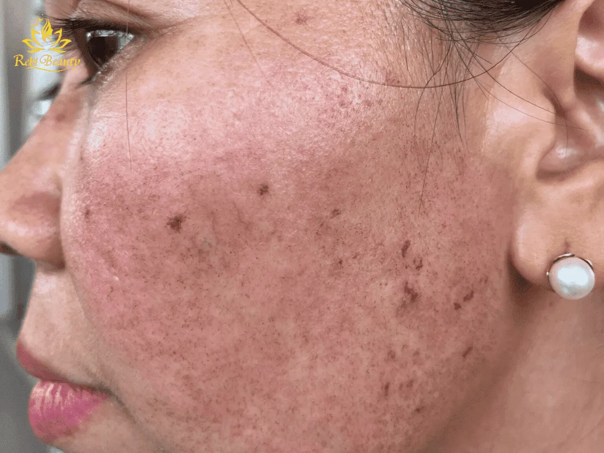 Mức độ tăng sắc tố còn phụ thuộc vào độ nhạy cảm của da