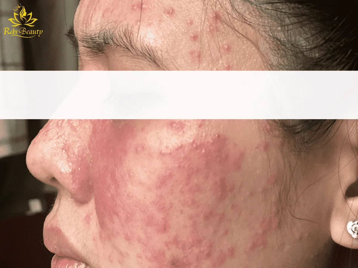 Mụn nước & mụn viêm có thể là do dị ứng với mỹ phẩm