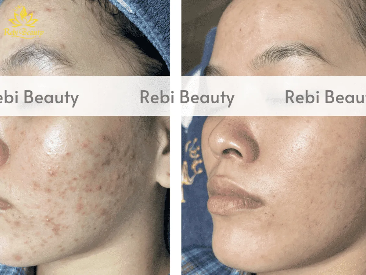 Peel da còn có tác dụng kháng viêm, kháng khuẩn, giúp ngăn ngừa mụn hình thành
