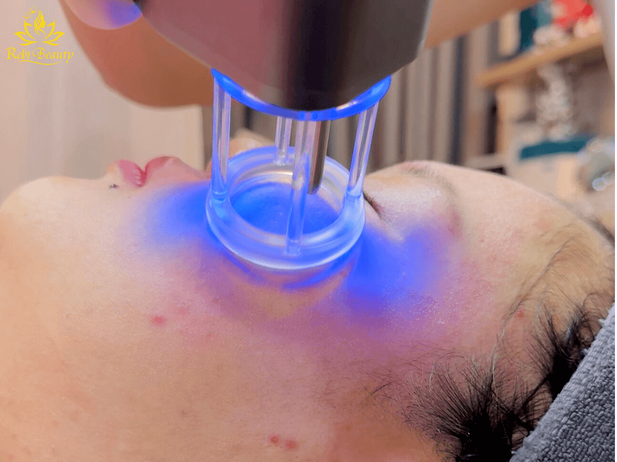 Ánh sáng laser giúp tiêu diệt nhân mụn và vi khuẩn ẩn nấp dưới da