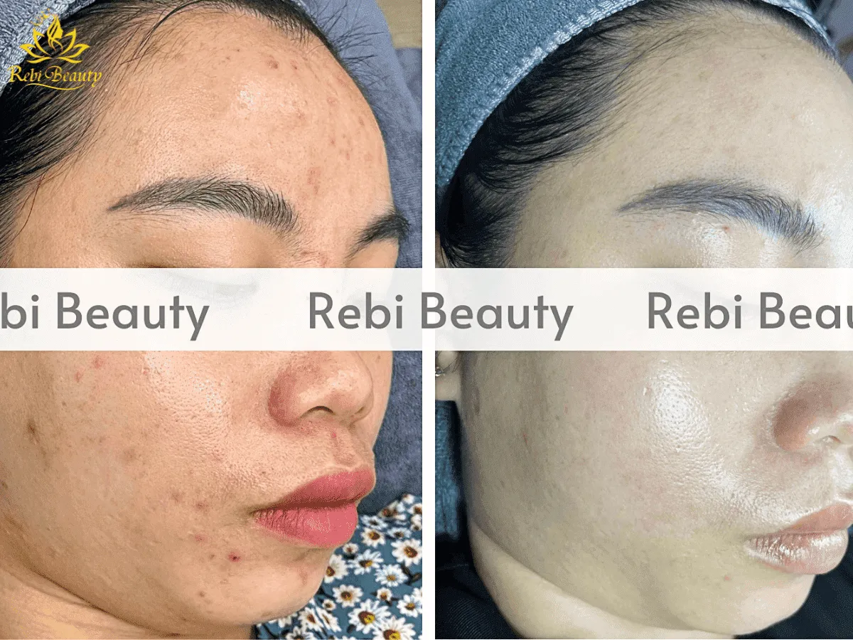 Để điều trị mụn triệt để phải hiểu làn da mình đang bị gì và cần gì Để điều trị mụn triệt để phải hiểu làn da mình đang bị gì và cần gì