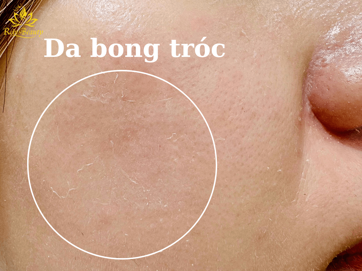 Làn da bong tróc là dấu hiệu của việc thiếu nước, nên cần phải cấp ẩm