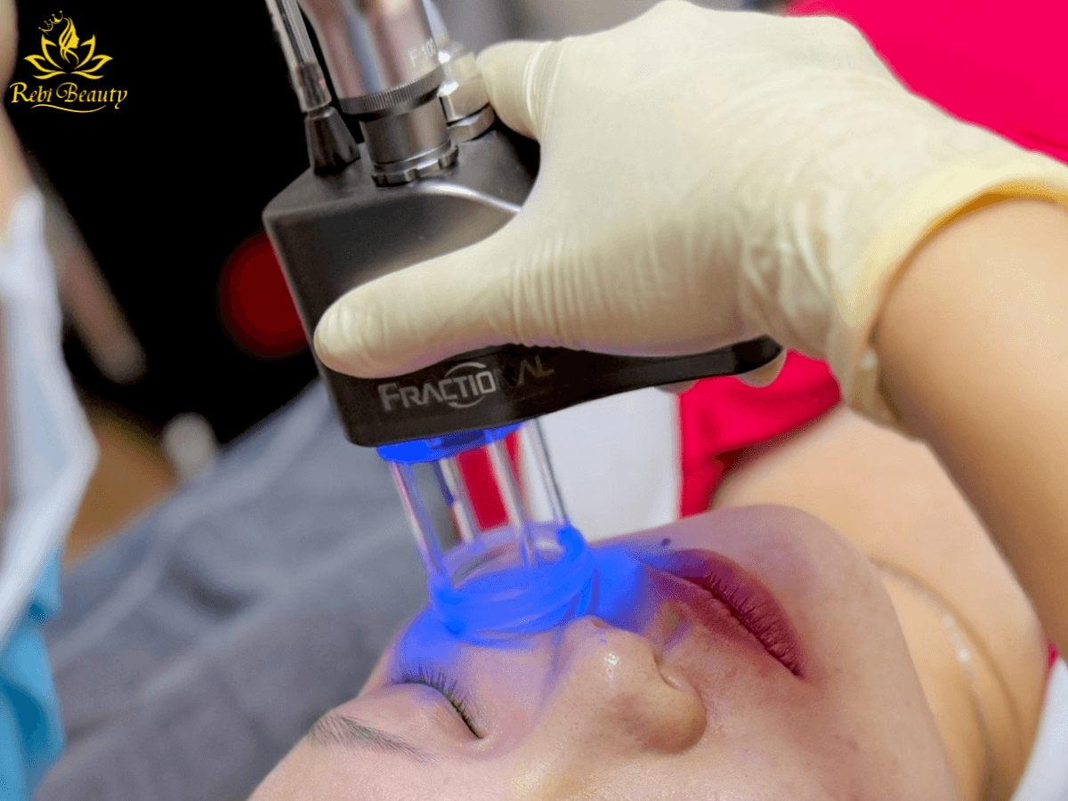 Laser CO2 Fractional là khả năng ngăn chặn sự lây lan của mụn cơm sang các vùng da xung quanh