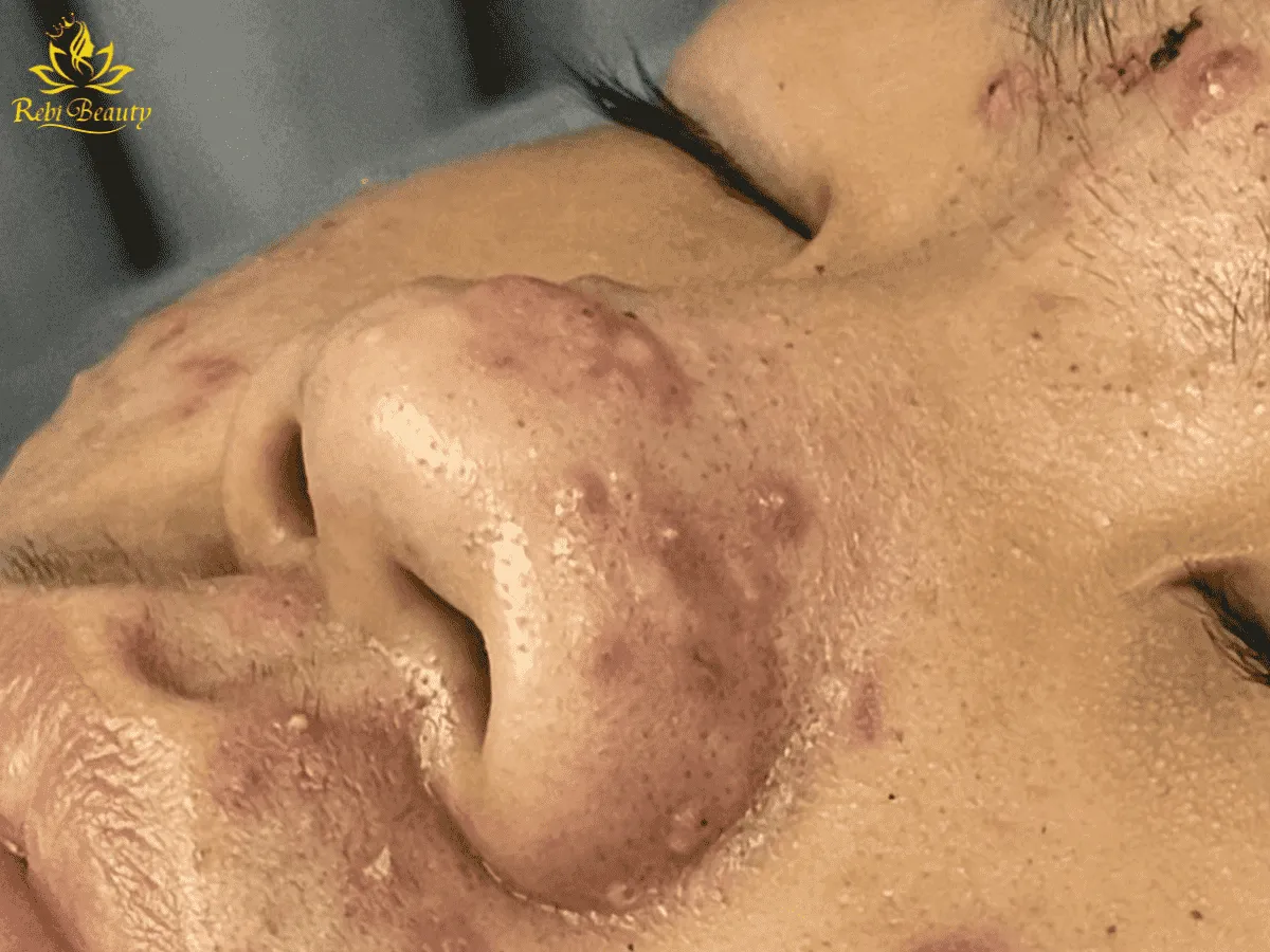 Mụn trên mũi đôi khi là dấu hiệu của những vấn đề sức khỏe tiềm ẩn