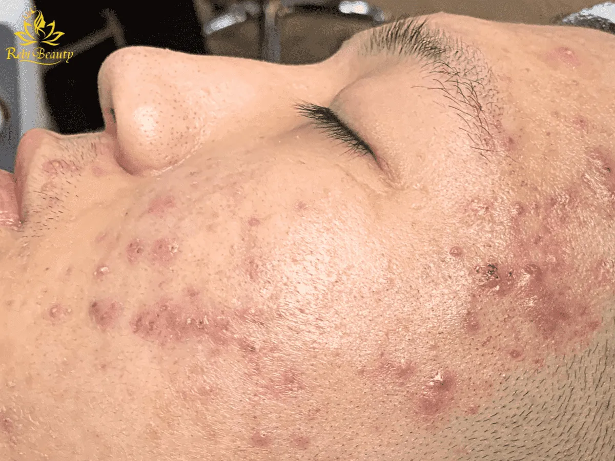 Mụn li ti là những nốt mụn nhỏ có thể ẩn sâu trong da hoặc nổi lên trên bề mặt da