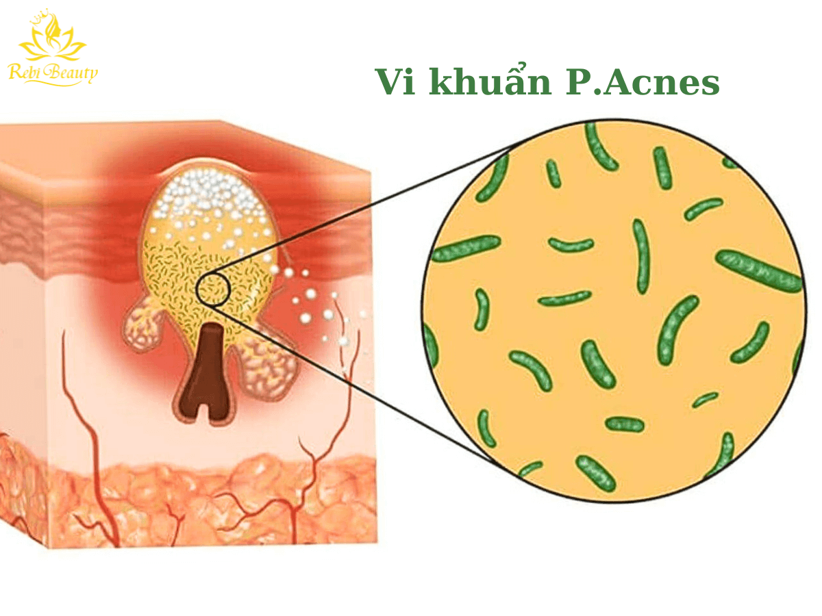 P.acnes là loại vi khuẩn chủ yếu gây nên mụn trên da