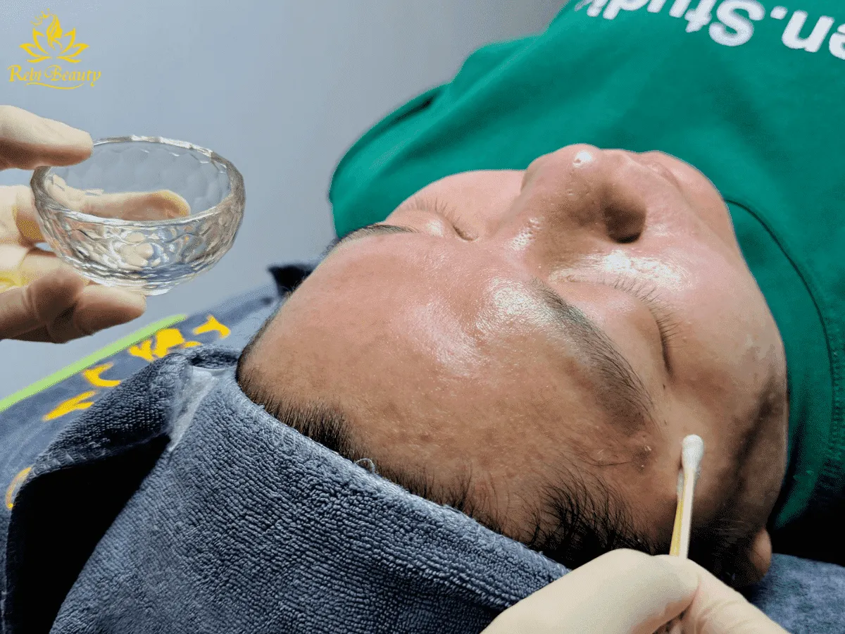 Peel da là một trong những phương pháp điều trị mụn ẩn hữu hiệu