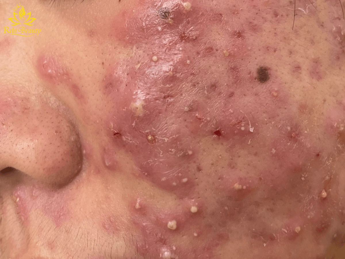 Vi khuẩn P.acnes đóng vai trò chủ chốt trong việc gây ra mụn cứng