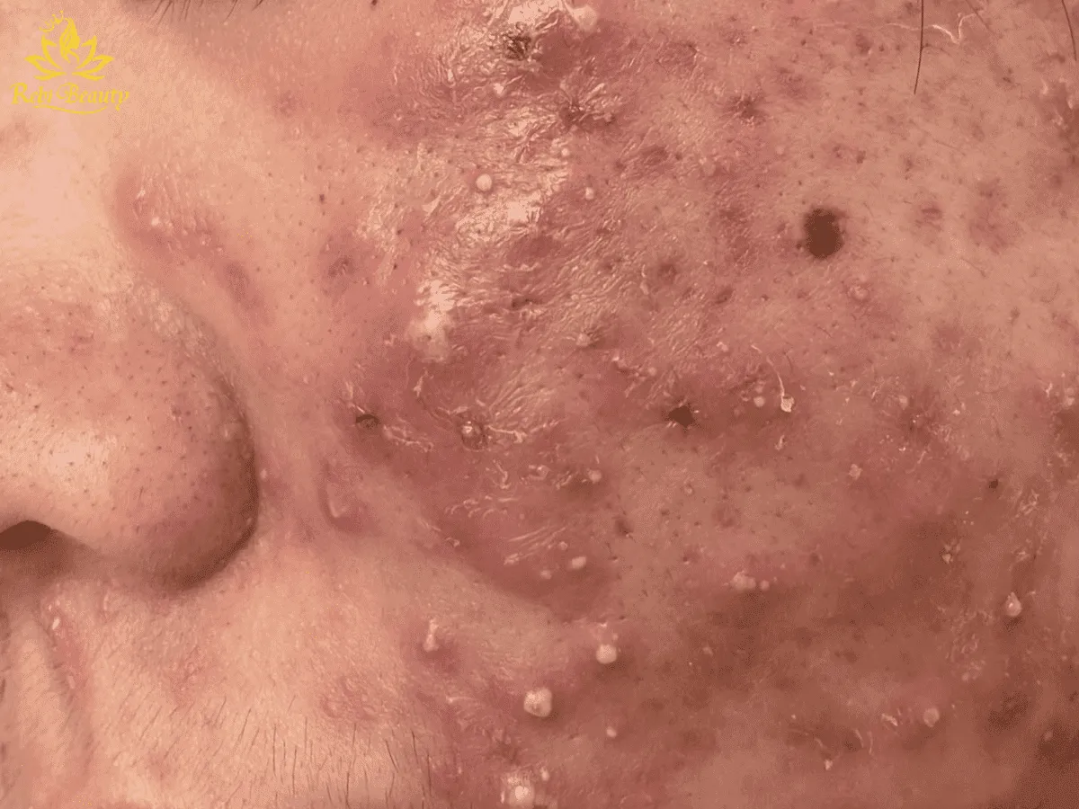 Vi khuẩn P.acnes đóng vai trò chủ chốt trong việc gây ra mụn cứng