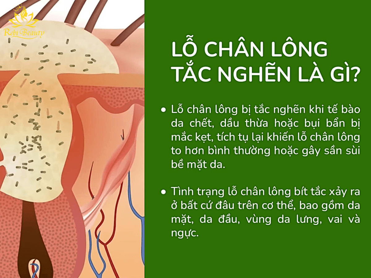 Việc đeo khẩu trang thường xuyên có thể làm tình trạng lỗ chân lông bị bí tắc