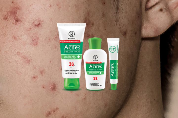 Bộ sản phẩm trị mụn Acnes