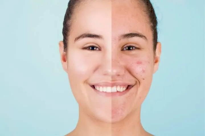 Khả Năng Chống Mụn Của Bột Lá Neem