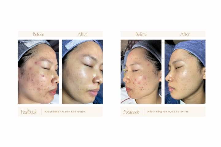 Trị Mụn Ở Đâu An Toàn: Lựa Chọn Chuẩn Y Khoa Rebi Beauty Spa
