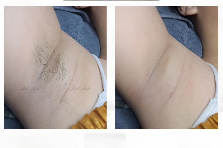 Mai Anh Spa Quận 11