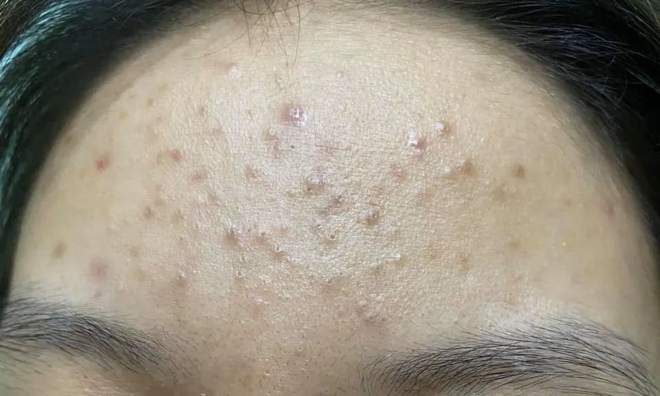 4 Cách Hết Mụn Ẩn Ở Tuổi Dậy Thì – Trị Triệt Để - An Toàn – Tiết Kiệm