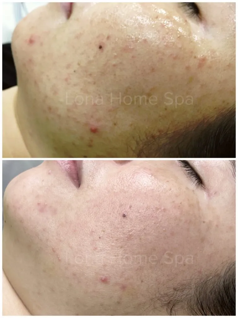 Hình ảnh quá trình tư vấn và điều trị mụn chuyên sâu tại một phòng khám da liễu uy tín ở Cần Thơ.