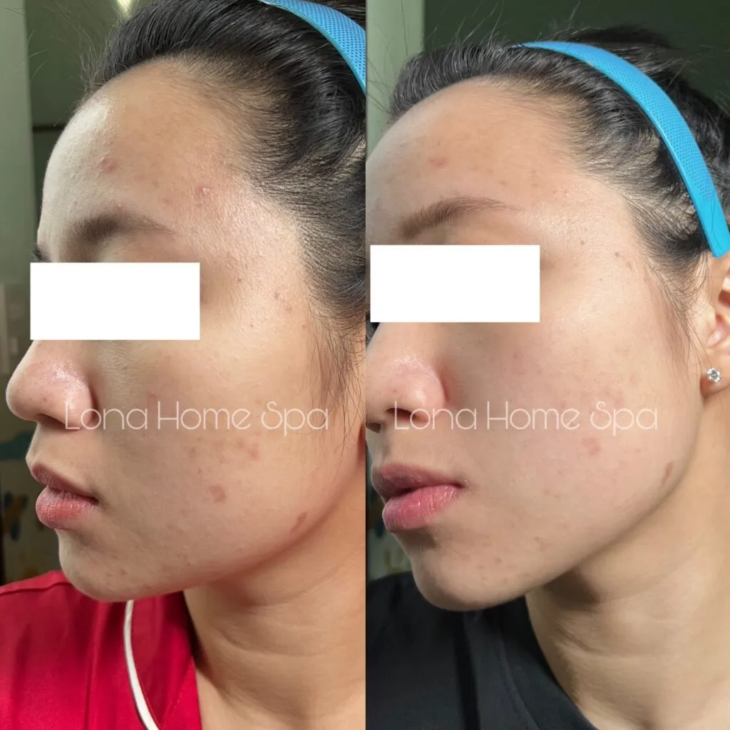 Ứng dụng công nghệ laser tiên tiến trong liệu trình trị mụn bởi bác sĩ chuyên khoa ở Cần Thơ.