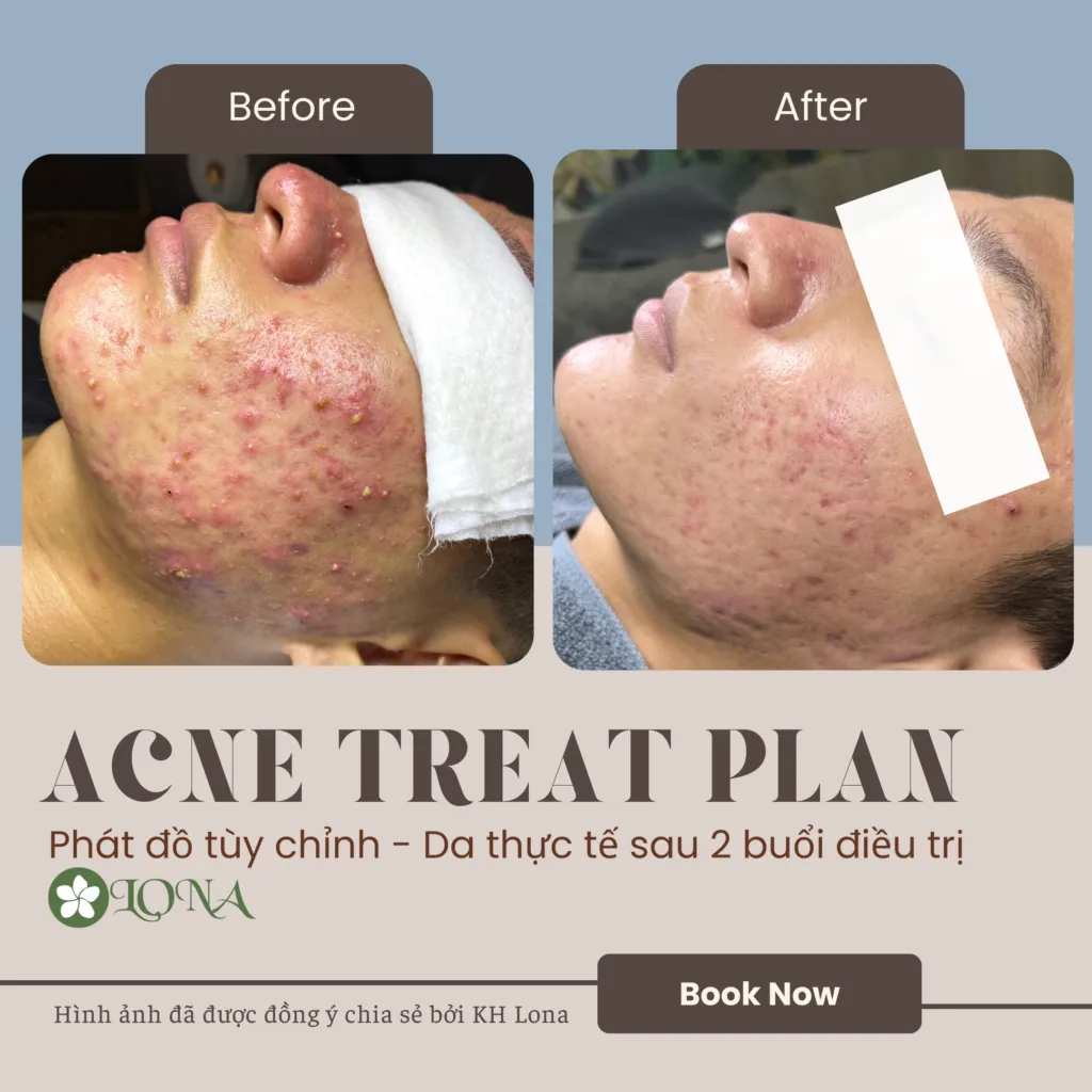 Cận cảnh quy trình chăm sóc da mặt tại phòng khám da liễu chuyên trị mụn ở Cần Thơ.