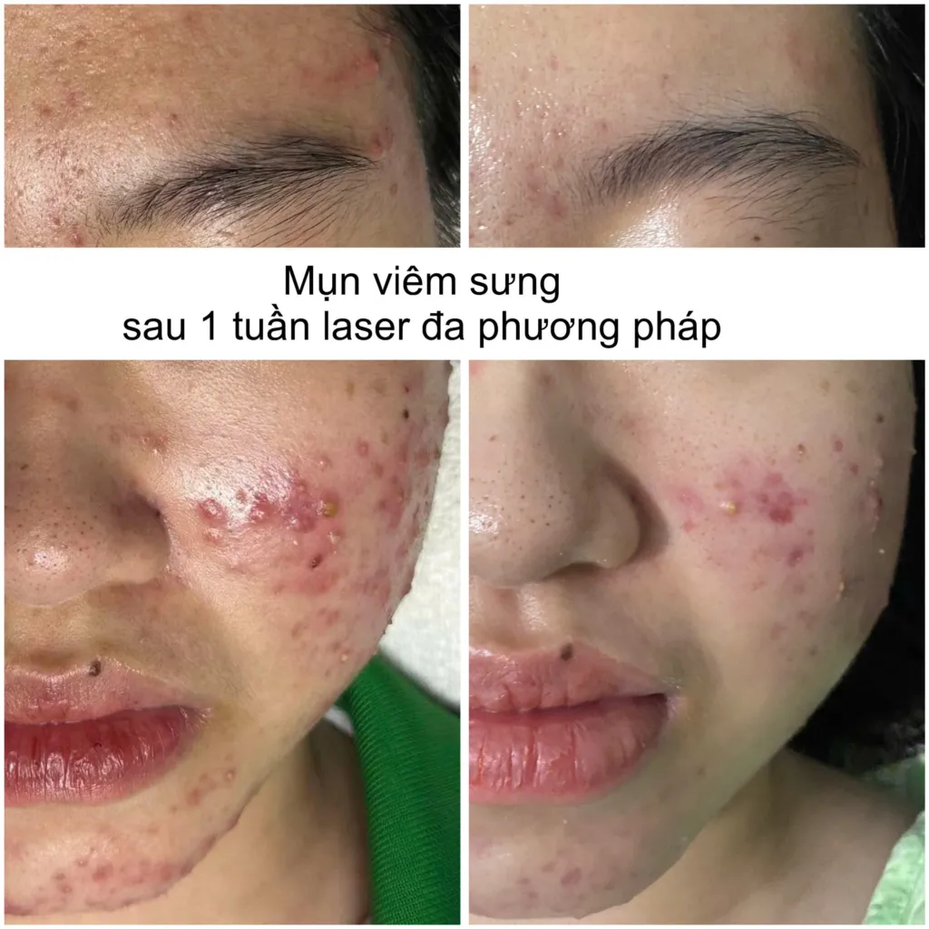 Kết quả điều trị mụn hiệu quả tại spa chuyên sâu ở Cần Thơ, với sự hỗ trợ từ chuyên gia.