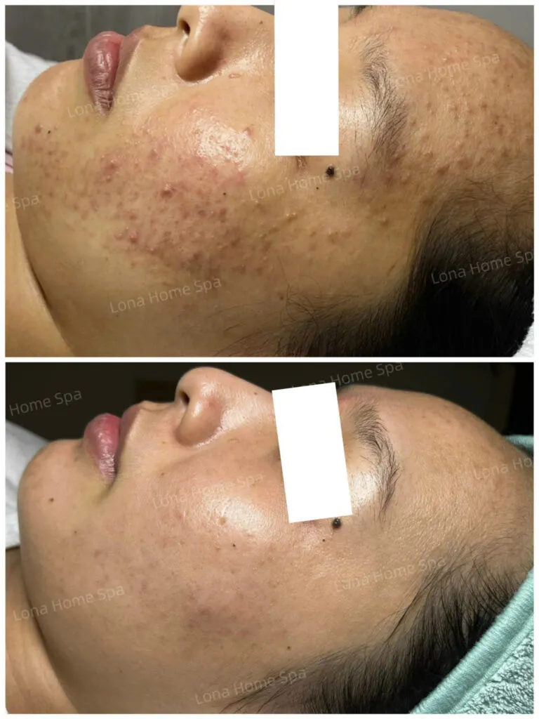 Quy trình chăm sóc da mụn chuyên nghiệp tại cơ sở da liễu hàng đầu Cần Thơ.