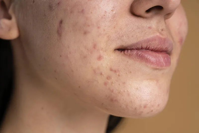 Bí kíp trị thâm mụn đúng cách và hiệu quả