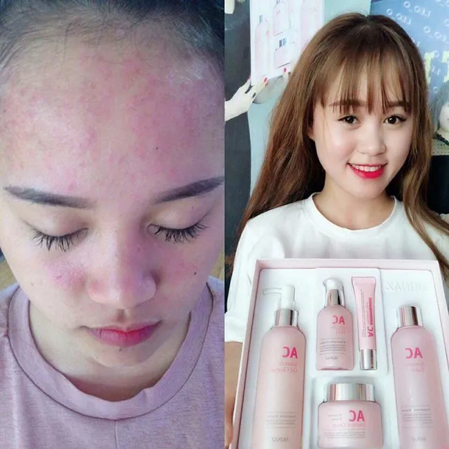 Bộ sản phẩm trị mụn Skinaz AC Sensitive Skin Care E phiên bản cải tiến mới nhất