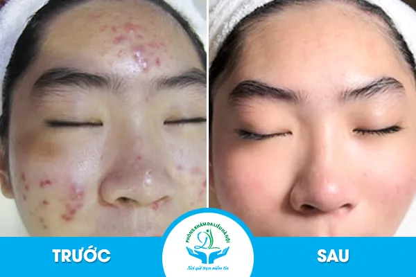 Hình ảnh khách hàng thành công sau liệu trình trị mụn bọc từ bên trong ở Rebi Beauty Spa