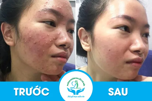 Giải pháp trị mụn bọc từ bên trong hiệu quả, mang lại làn da khỏe mạnh