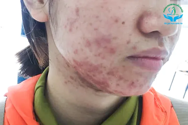 Trị mụn bọc từ bên trong: Quy trình chăm sóc da mụn đúng cách