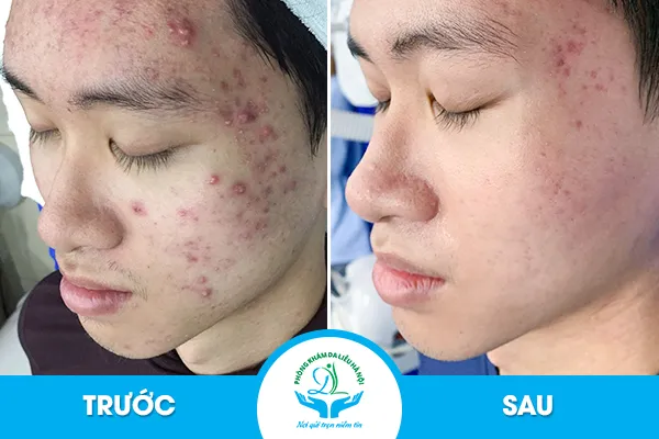 Trải nghiệm trị mụn bọc từ bên trong với công nghệ tiên tiến tại Rebi Beauty Spa