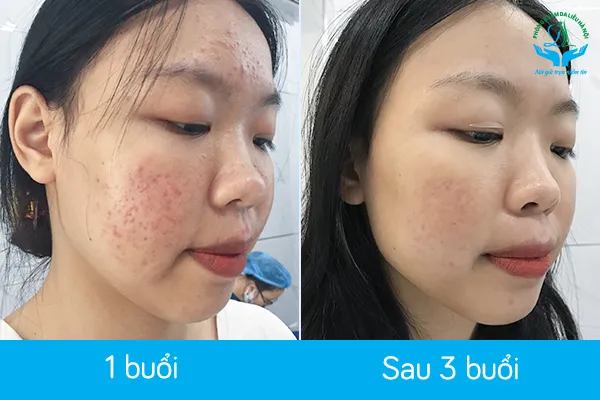 Kết quả điều trị mụn thành công tại một phòng khám da liễu uy tín ở Hà Nội