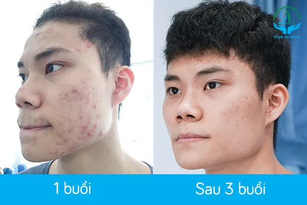Sự thay đổi tích cực của làn da sau liệu trình trị mụn tại phòng khám da liễu Hà Nội