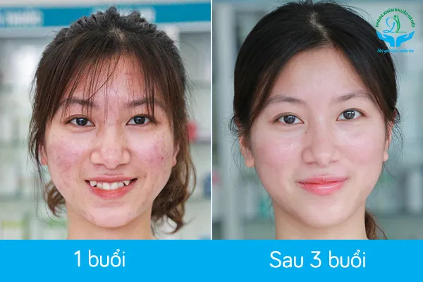Hình ảnh trước và sau khi trị mụn tại phòng khám da liễu chất lượng cao tại Hà Nội