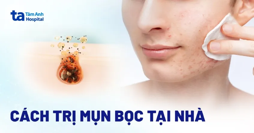 Cach Tri Mun Boc Bi Chai Hieu Qua Va An Toan Tai Nha Image 1