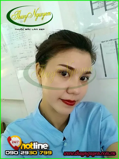 Làn da hoàn hảo, sạch mụn thâm, ẩn, bọc sau khi kết thúc liệu trình điều trị chuyên sâu.