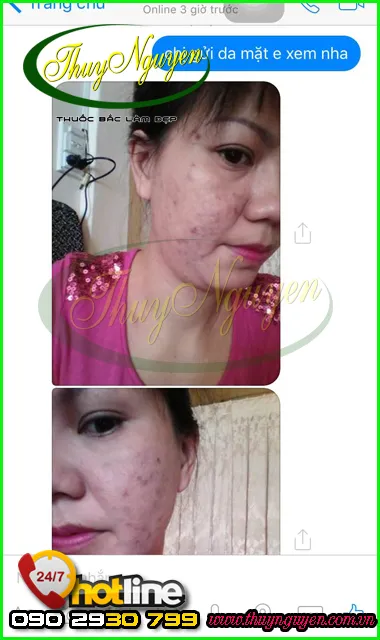 Tình trạng da mặt ban đầu với mụn thâm, mụn ẩn, mụn bọc và lỗ chân lông to trước khi điều trị.
