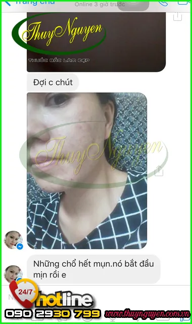 Làn da không còn mụn thâm, ẩn, bọc sau 5 tuần điều trị, da trở nên mịn màng và sáng hơn.