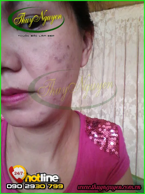 Góc nhìn bên trái khuôn mặt khách hàng TN14066 với tình trạng mụn bọc, mụn ẩn và thâm trước khi bắt đầu liệu trình.