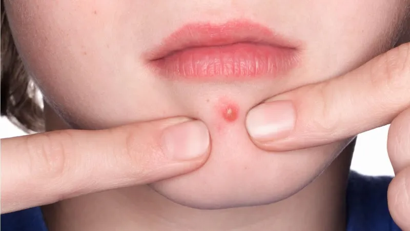 Mụn đầu đinh sưng đỏ gây đau nhức khó chịu