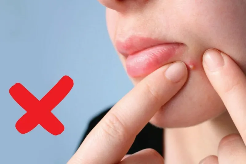 Da mặt bị mụn đầu đinh không nên tự ý nặn, cần áp dụng cách trị mụn đầu đinh dân gian đúng cách