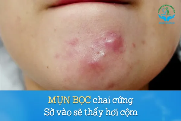 Cách trị mụn bọc từ bên trong: Hình ảnh mụn bọc chai cứng trên da